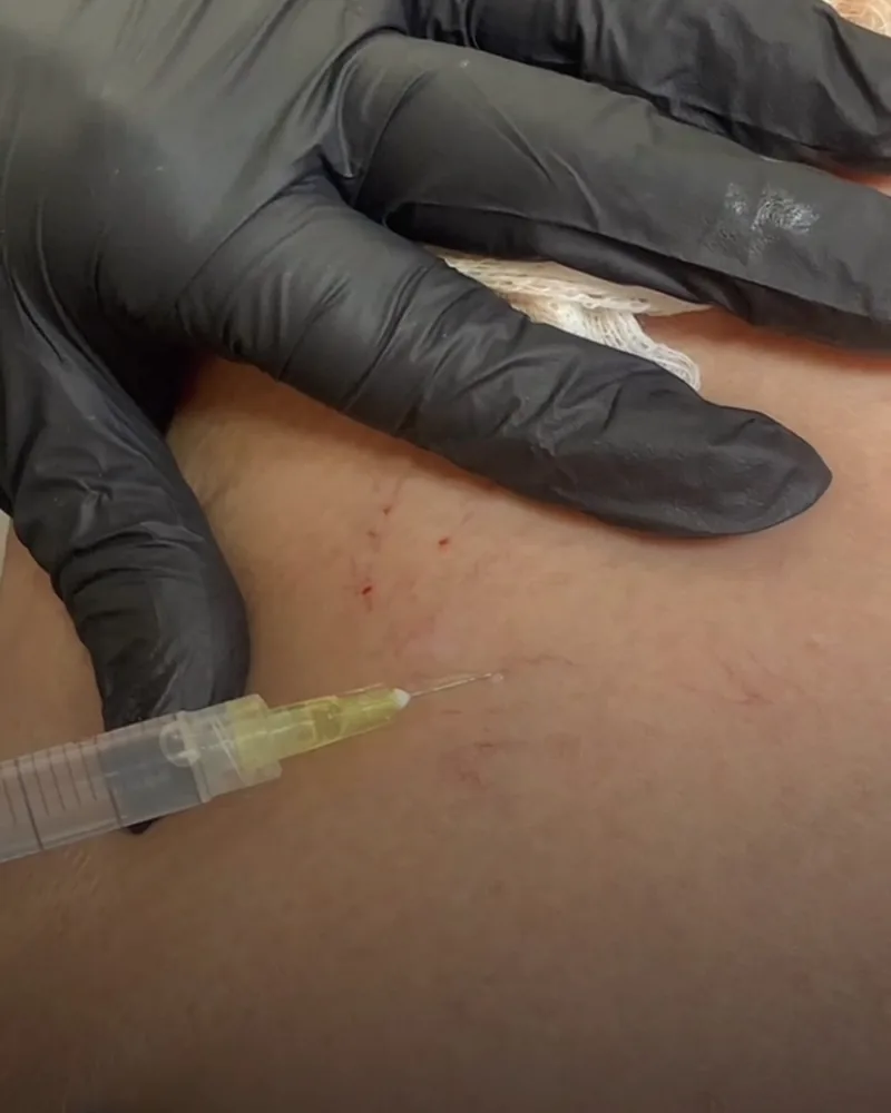 Carboxiterapia — fotografia fornecida pela clínica