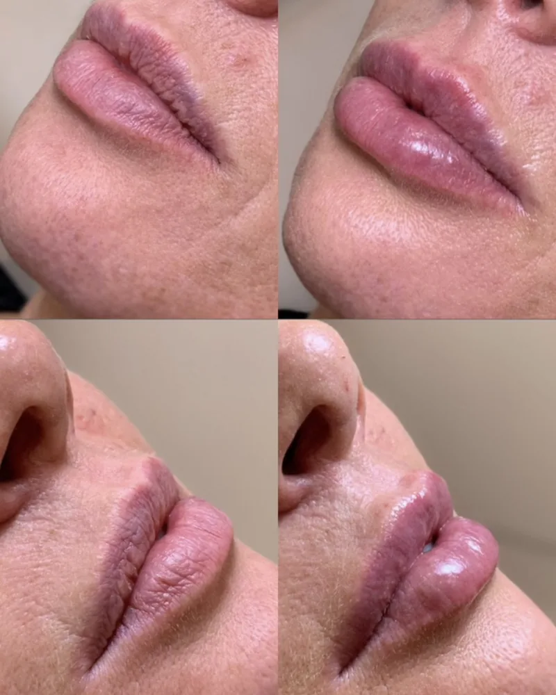 Preenchimento labial — fotografia fornecida pela clínica